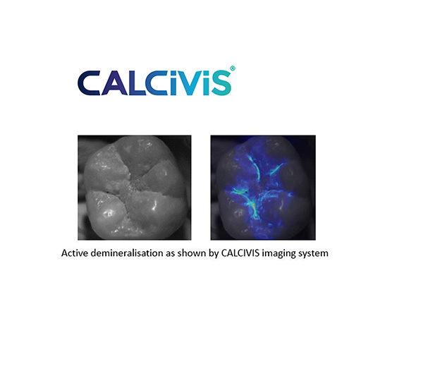 CALCIVIS® – The Brand New Demineralisation Detection Device