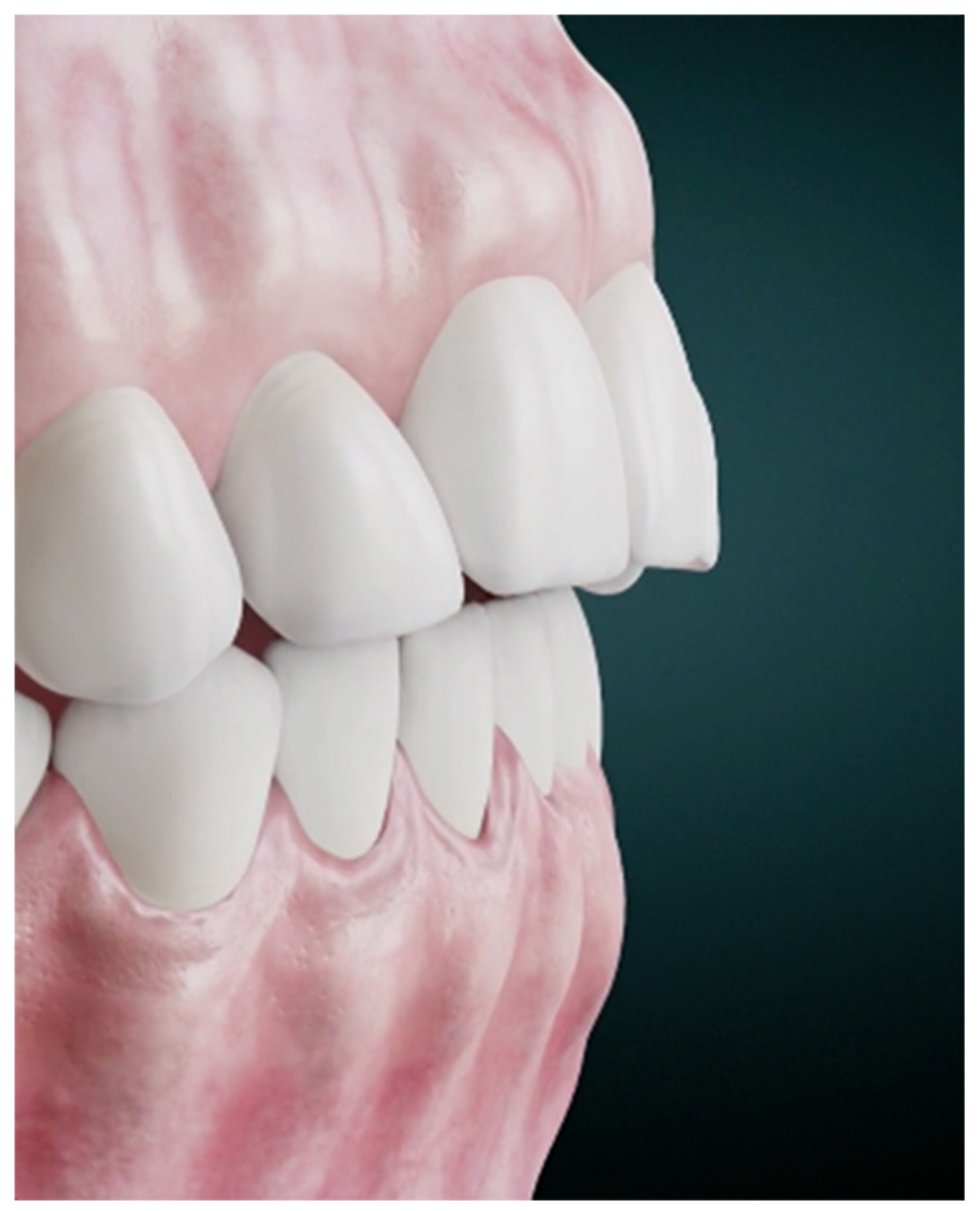 Erosion – an increasingly common cause of tooth wear