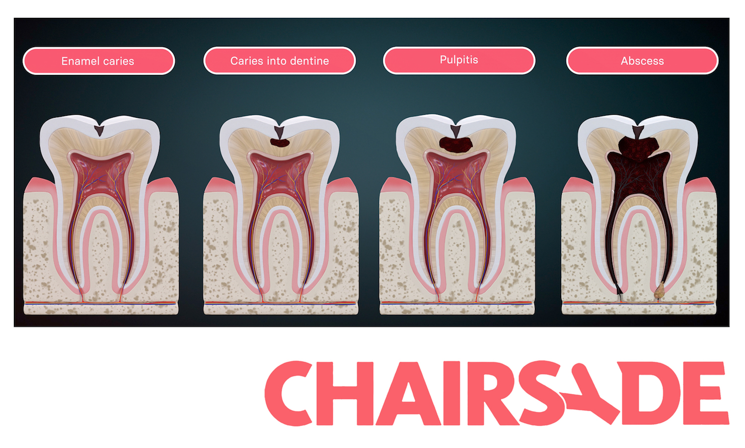 Health literacy in the fight against dental caries