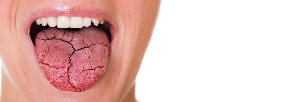 Diagnosing and managing dry mouth