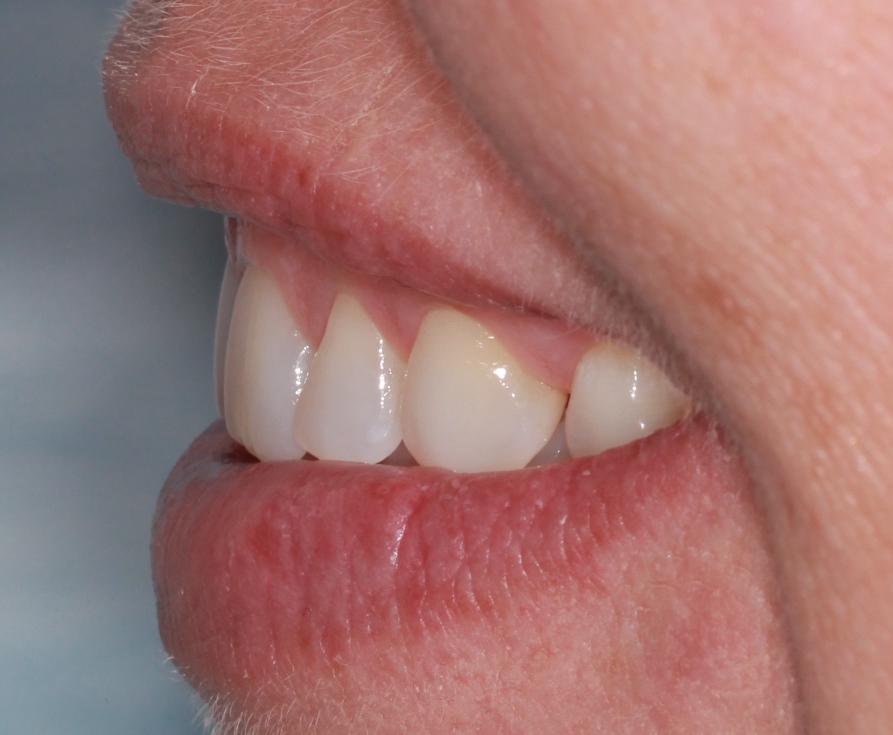 A simple, minimally invasive solution for crowding and diastema closure