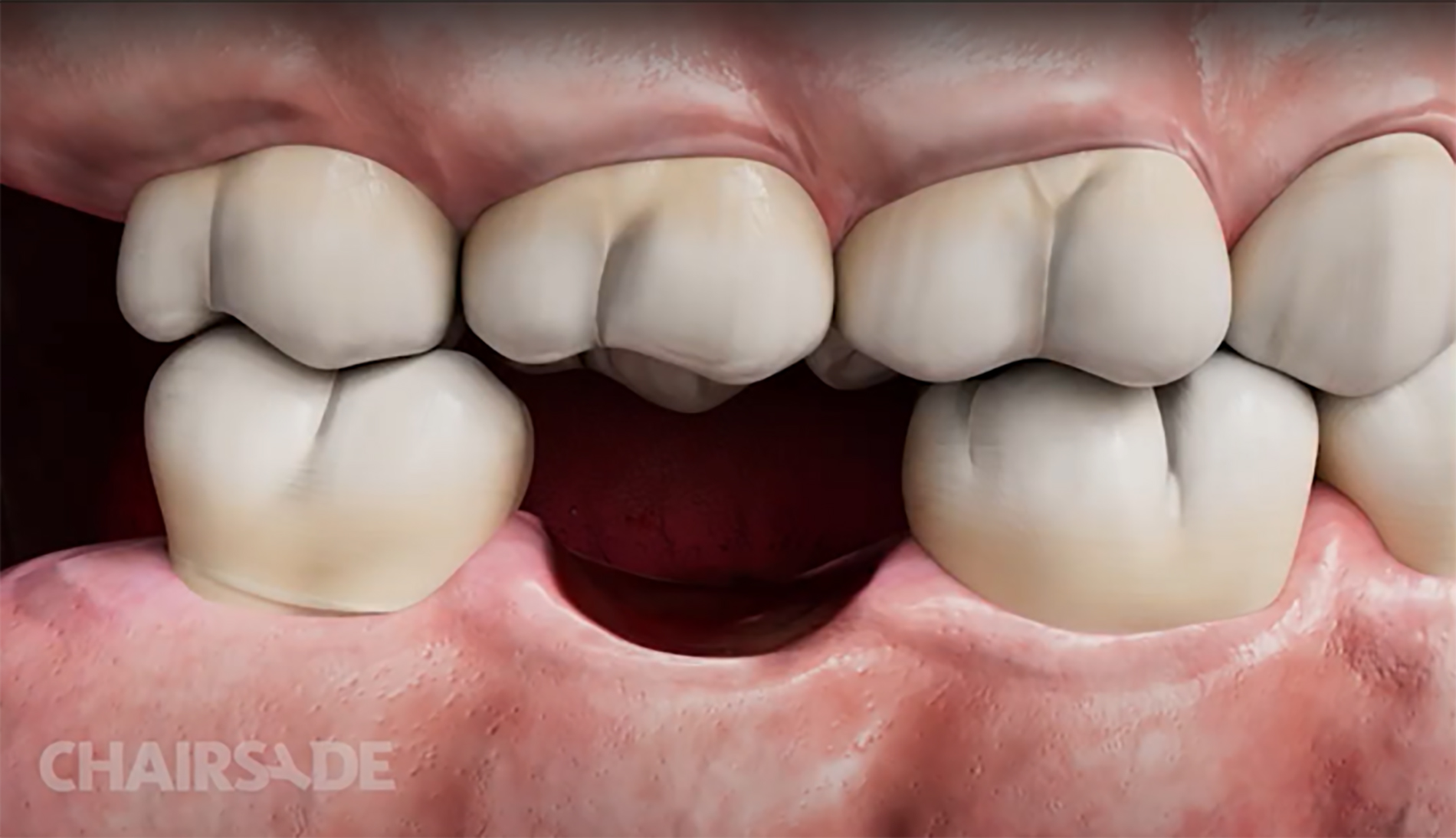 Reducing implant complications with improved patient behaviours