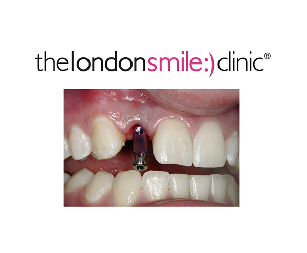 Comprehensive Implant Surgery Made Easy