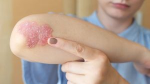 Psoriasis made simple