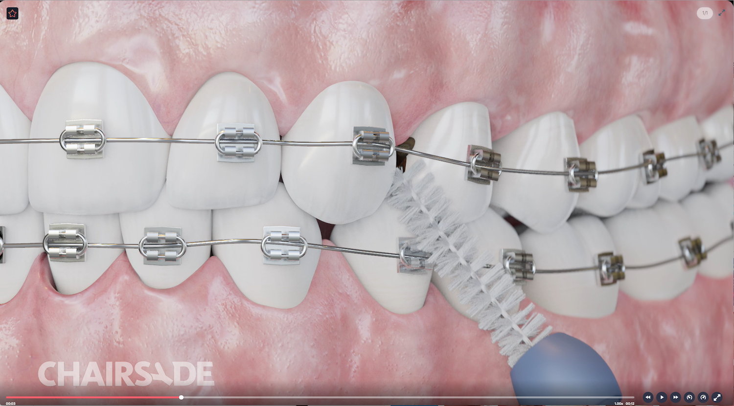 Optimising oral hygiene for orthodontics