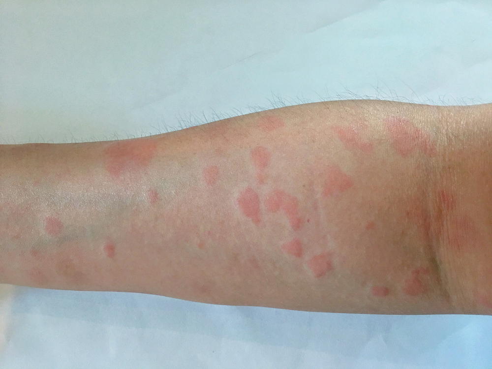 Lupus – an autoimmune disease with profound consequences