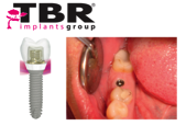 Case selection for dental implant treatment – Mr Luc Trevisan TBR  Development Director