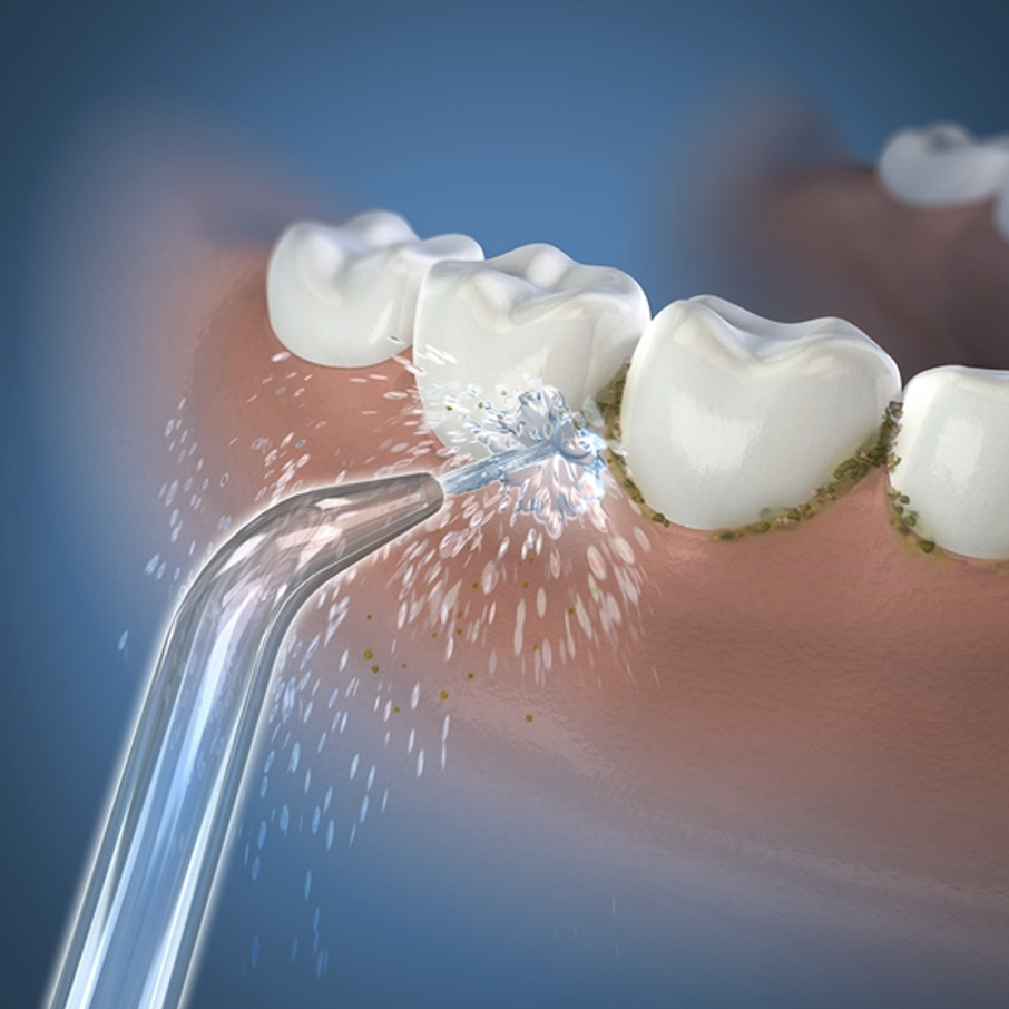 Blitzing plaque with efficiency