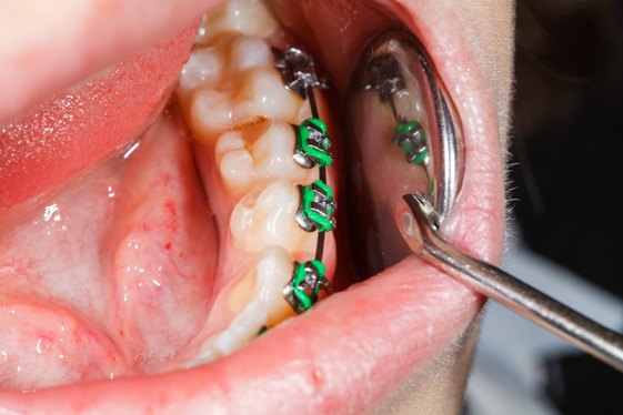 Orthodontic legal challenge: Update