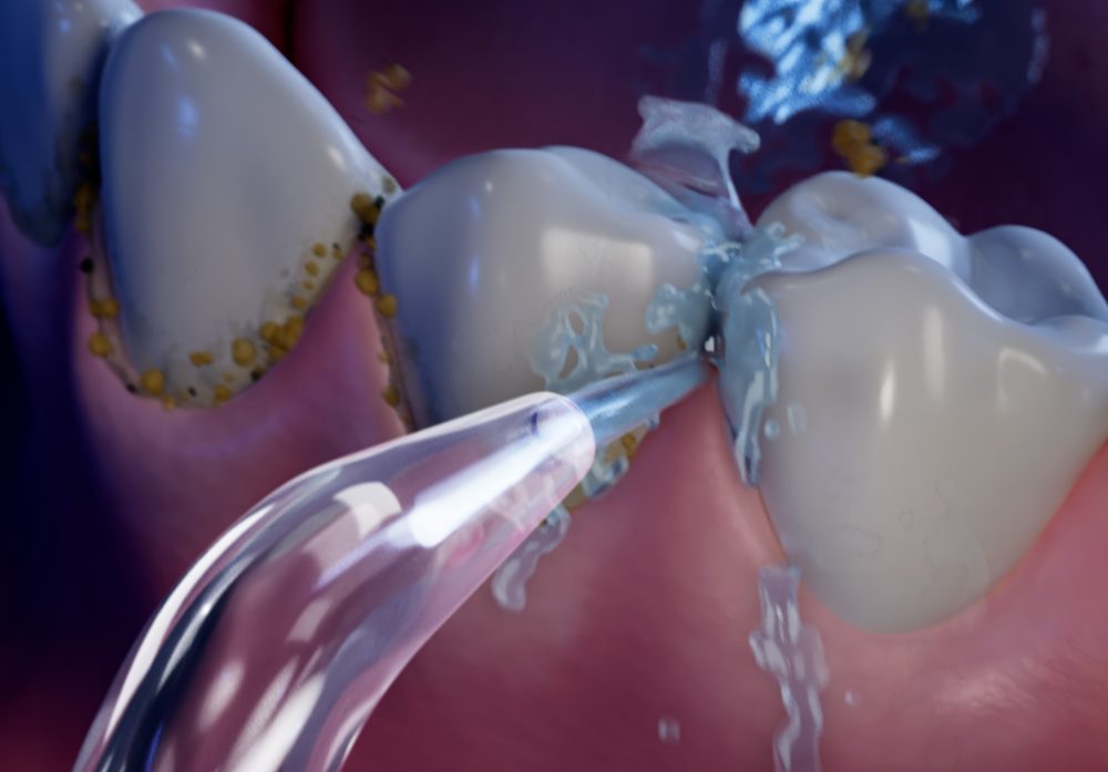 Are you recommending water flossing?